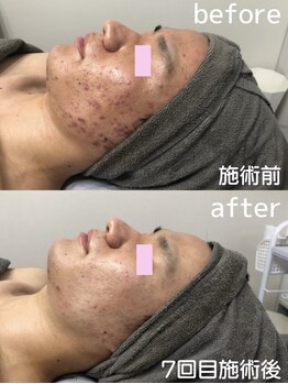 スピカ(Spica)/REVI陶器トリートメント