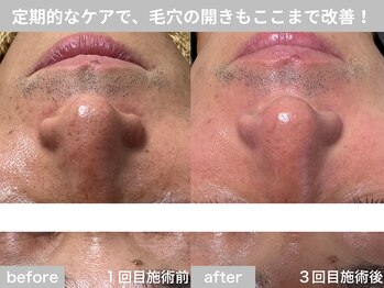 サロン ビュー(salon view)/30代男性〈毛穴開き悩み〉