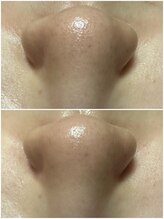 エステルーム クリスタル/プラズマ×毛穴洗浄