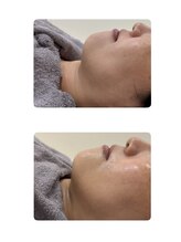 ナルフロウ(nalufurou)/RED SHOT☆脂肪分解美容液