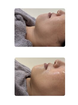 ナルフロウ(nalufurou)/RED SHOT☆脂肪分解美容液