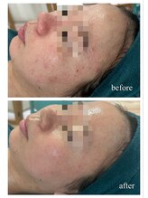 リノルーア(Linolua)/繰り返す肌荒れにはハーブ