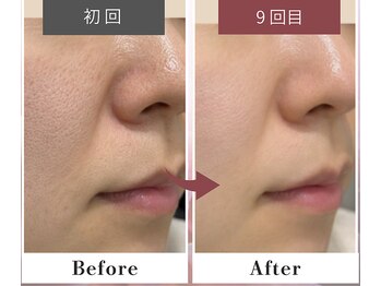 フルリール/【毛穴＋顔脱毛＋ビタミン導入】