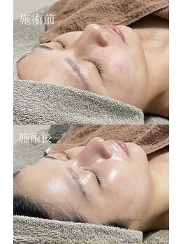 クレヴィー(Creviy)/シルク入りハーブピーリング