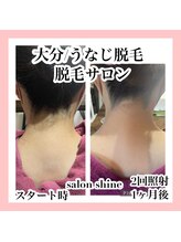サロンシャイン(Salon Shine)/うなじ脱毛経過