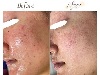 ミラリー(MIRALY)/敏感ニキビ肌ケア8ヶ月(20代)