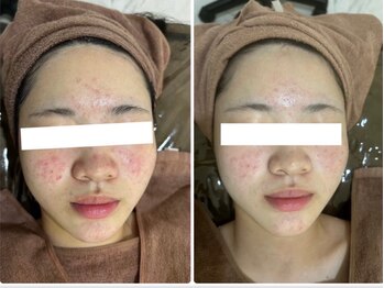 ホワイトアクア 四日市店(WHITE AQUA)/ニキビケア/ニキビ改善/美肌