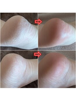 スノードロップ(snowdrop)/夏にピッタリ!かかとエステ