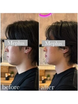 ミープラス(Me+)/小顔マイクロ波リフト
