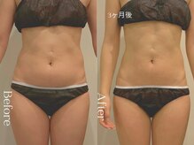 ユーフォリア グロウ(euphoria glow)/｛　ラフォス痩身90分 15回　}