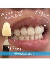 歯のホワイトニングWhiteningCafe六本木店【ホワイトニングカフェ】/ホワイトニング施術写真