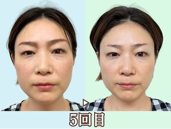 ナチュラルビューティーフェイス 横浜(NBF)/お肌のコンディションも変わる