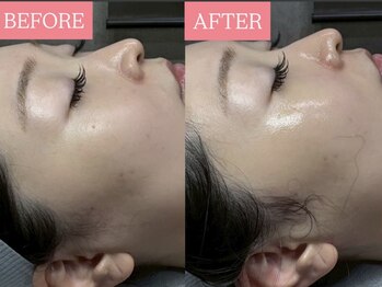 オンフリーク(ON FLEEK)の写真/《毛穴洗浄×韓国最新ピーリング》で肌育を♪肌悩み知らずのハリ艶溢れる素肌へ♪施術後すぐに効果を実感！