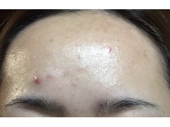 ララ オートクチュール(LALA HAUTOCOUTURE)/ニキビ/くすみ/ザラつき