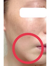 ツクヨミ/フェイスリフト