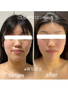ソラ(sola*)/顎がシャープにスッキリ小顔