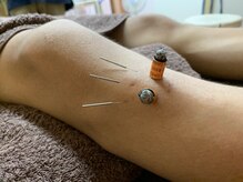 長野鍼灸治療院/オスグッド鍼灸施術