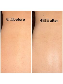 ミニョン(mignon)/背中の毛穴も引き締めて背中美人