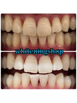 ホワイトニングショップ 大阪玉造店/Before&After美白ホワイトニング