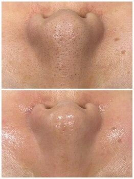 ララシエラ 新潟駅前店(LalaSierra)/毛穴ケア♪いちご鼻も撃退！！