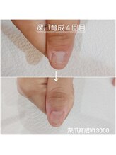 ピピ(PiPi)/【深爪育成】