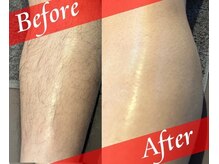 濃い毛に自信あり◎メンズ脱毛/全身脱毛/ヒゲ脱毛/VIO脱毛