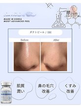 肌イズム 守谷店(肌ism)/【before&after】ダクトピール