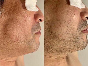 バタフライ 津田沼店(Butterfly)/美顔ヒゲ脱毛