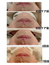 エミナル バイ ニコドット(Eminal by nico.)/鼻下の黒ずみ悩み（60代）