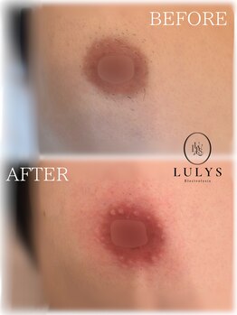 ルリス(LULYS)/乳輪脱毛