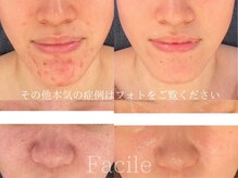 ファシル(Facile)