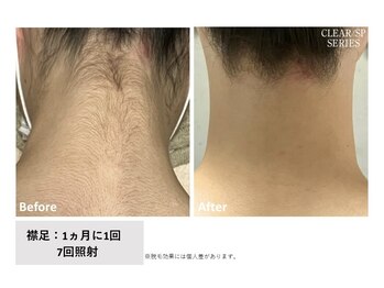 エミルカ(EMILUCA)/レディース全身脱毛