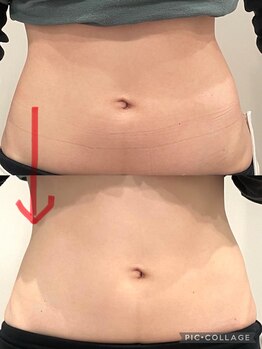 ルナート(Lunart)/腸もみの一回の変化