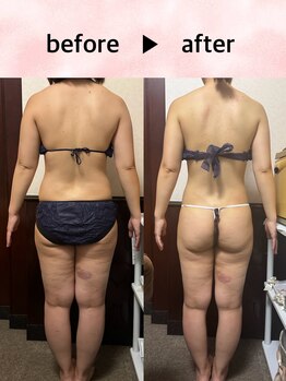 ユルリ 水戸本店(yururi)/腰回り、太ももサイズダウン！！