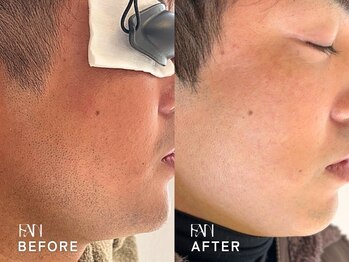 ファン(FAN)/【メンズひげ脱毛】BEFORE-AFTER