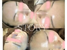 ストーリー(STORY)/ハーブピーリング専門店STORY