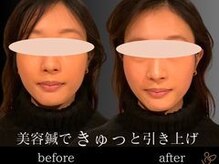 チョコバリ 渋谷店(chocobari)/小顔×リフトアップ(美容鍼)20代
