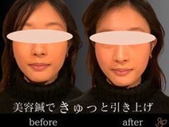 チョコバリ 渋谷店(chocobari)/小顔×リフトアップ(美容鍼)20代