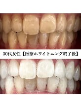 ホワイト 福岡博多店(WHITE)/ホワイトニングビフォーアフター