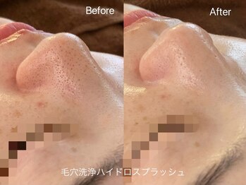 リアン(Lien)/毛穴洗浄ハイドロスプラッシュ