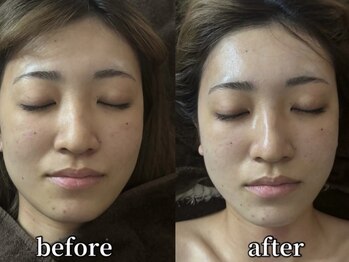 ボヌールデソワ(Bonheur de Soi)/ハーブピーリング/ニキビ/北堀江