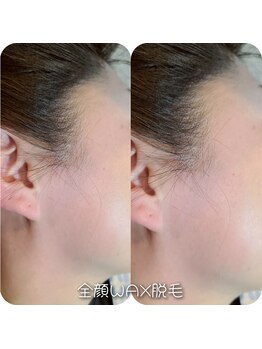 ルキナ(LUCINA)/全顔WAX脱毛