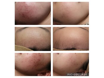 ベビースキン(baby skin)/ニキビ肌改善