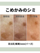 イーズ(eees)/こめかみのシミケア