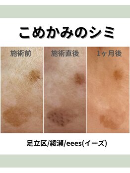 イーズ(eees)/こめかみのシミケア