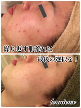 ル ミュー(le mieux)/剥離しないハーブピーリング