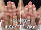 劇 的☆深爪矯正！Before→After