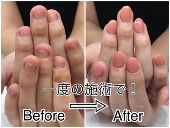 劇 的☆深爪矯正！Before→After