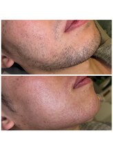 BWサロン(BW salon)/男性ヒゲWAX脱毛