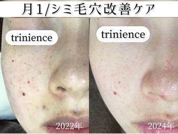 トリニエンス 新宿店(TRINIENCE)/20代/シミケア/肌質ケア